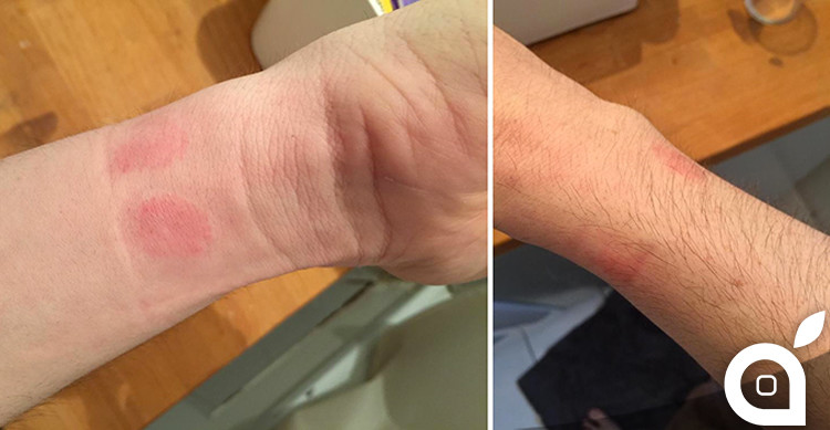 ｢Apple Watch｣が原因で皮膚炎に ｰ 一部のユーザーが報告